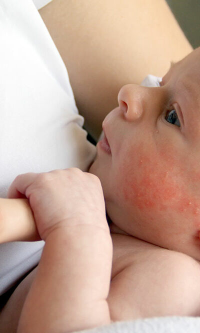 Prevent these infant skin issues to keep your baby’s skin flawless