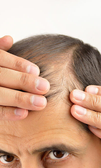 Top 4 reasons for unnatural hair loss patterns